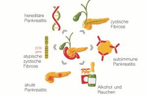 Chronische Pankreatitis Ursachen
