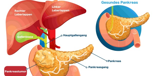Pankreaskarzinom