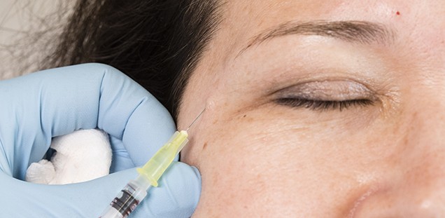 Faltenbehandlung mit Botulinumtoxin-A-Injektionen (Botox)