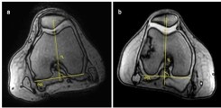 1.	Quantifizierung der lateralen Patellatranslation mithilfe Axiale CINE-Sequenz bei einem Normalprobanden (a) und Patienten mit Maltracking (b): Abstand (rote Linie) zwischen einer Tangente durch den trochlearen Sulcus (TL) in 90° zur posterioren Kondylenhinterkante (PCL) sowie der ebenfalls in 90° befindlichen Tangente durch das isometrische Patellazentrum (gestrichelte Linie).