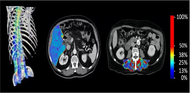 Fettquanzifizierung in der Spektral CT