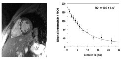 1.	Kurze-Achsen Ansicht (TE = 8.3ms) einer EKG getriggerten R2* Sequenz bei einem Thalassämie Patienten (33 J) (single breath-hold multi-echo Methode, 1.5 T). Mittels Setzen einer Region of Interest (ROI) im myokardialen Septum wird die mittlere Signalintensität ± SD pro Echo ermittelt. Der anschließende Exponential-Fit liefert eine erhöhte kardiale Relaxationsrate R2* = 106 Hz (T2* = 9.4ms).