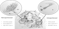 Peritoneal Metastasis in Ovarian Cancer