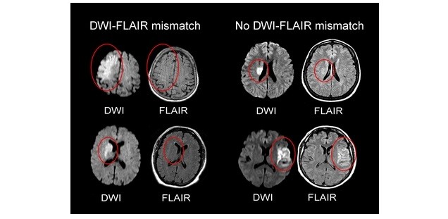 DWI-Flair-mismatch