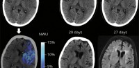 Reversible Ischemic Lesion Hypodensity