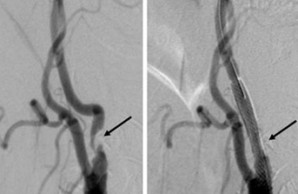 Stent in der Halsschlagader