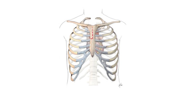 Minimal-invasiver Aortenklappenersatz