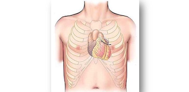 Minimal-invasive Bypass-Operation (MIDCAB Verfahren)