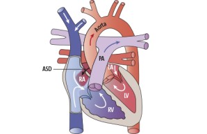 ASD | Vorhofseptumdefekt (Vorhofscheidewanddefekt)