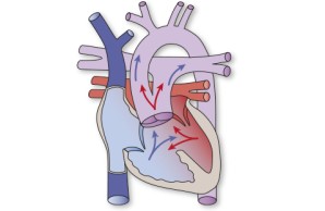 TAC | Truncus arteriosus communis 