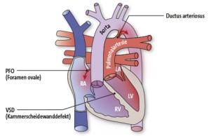 TGA | Transposition großer Arterien