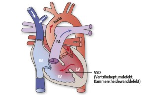 VSD | Ventrikulärer Septumdefekt (Kammerscheidewanddefekt)